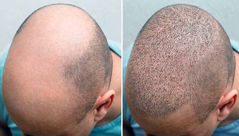 قبل وبعد: النتائج الحقيقية لجراحات زراعة الشعر