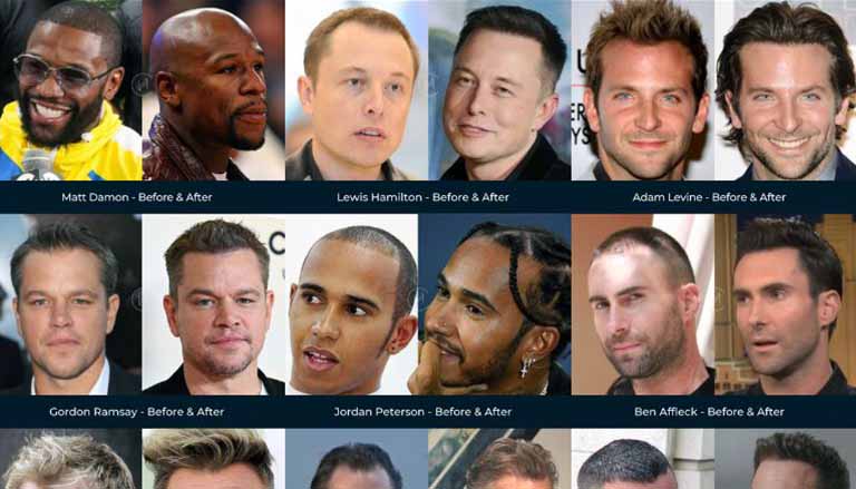 CELEBRITY HAIR TRANSPLANTS: WHO’S HAD THEM AND WHO HASN’T?