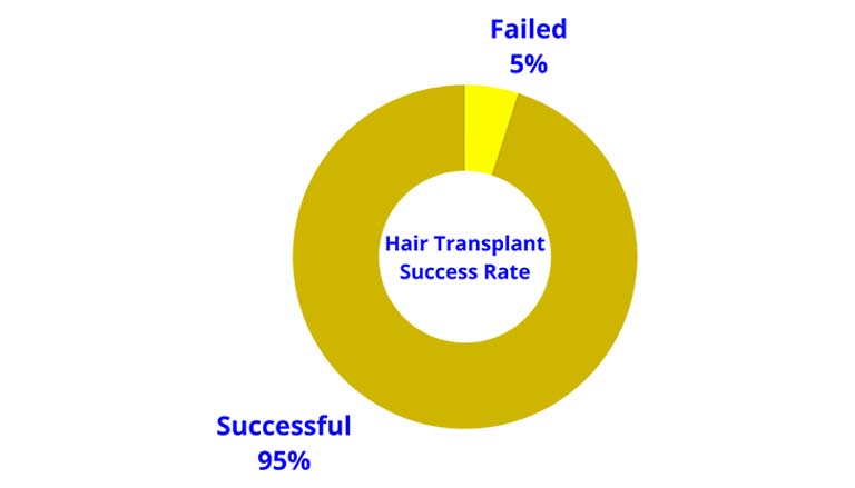 THE SCIENCE BEHIND HAIR TRANSPLANT SUCCESS